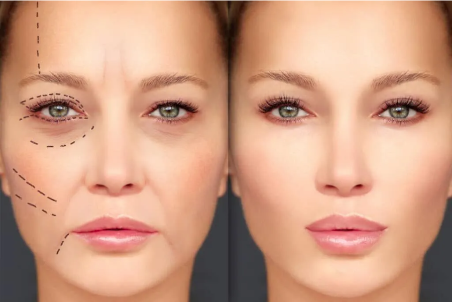 Dermal Fillers 